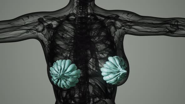 Medical Scan of Woman Breast Cancer