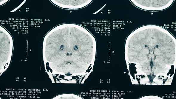 Xray Magnetic Resonance Image of Head