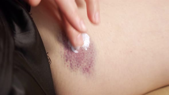 Young Woman Applies White Cream on Purple Thigh Bruise
