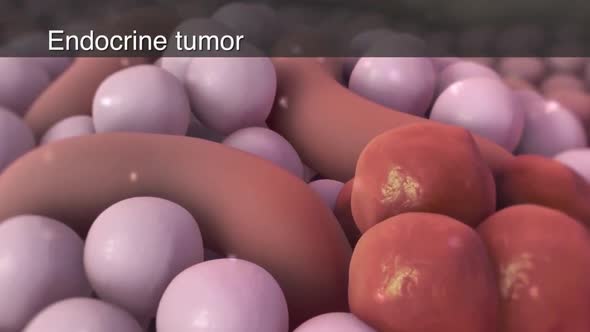 pancreatic cancer  medical animation