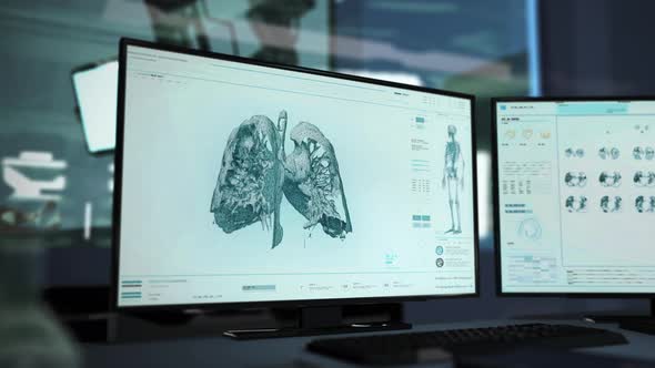 High Tech Medical Software Diagnosed Cancer During Scan Of Patients Lungs alt