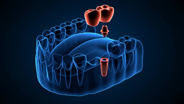 Jaw with implant supported dental cantilever bridge on dark blue background