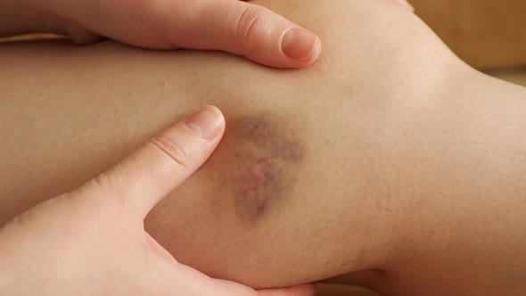 Woman Examines and Feels the Bruise on Her Leg