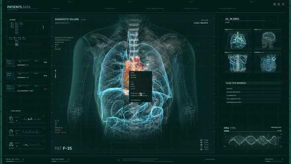 Laboratory analysis of the patients heart organ has diagnosed Cardiac Ischemia alt