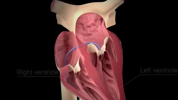 Arrhythmia The normal electrical activity of the heart is the result of the electrical activity