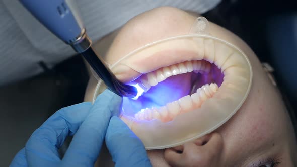 Close Up of Patient with Cheek Retractor in Mouth at Dental Clinic