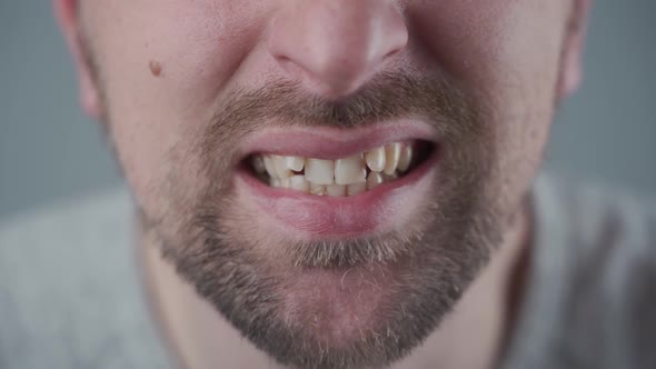 Malocclusion in Young Caucasian Male Crowded Upper Teeth