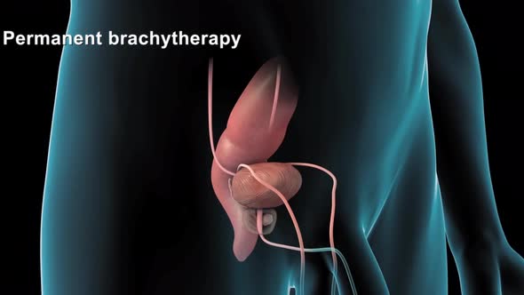 Medically accurate 3d animation of prostate cancer