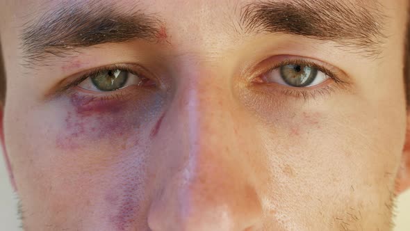 Portrait of a European Man with Bruises Under His Eyes
