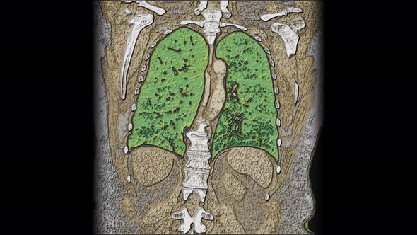 Bulk Multicolored MRI of the Lungs and Bronchi, Diagnosis of Viral or Covid-19 Respiratory Disease