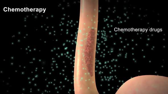 Chemotherapy is applied to the tumor areas and the tumor is cleared.