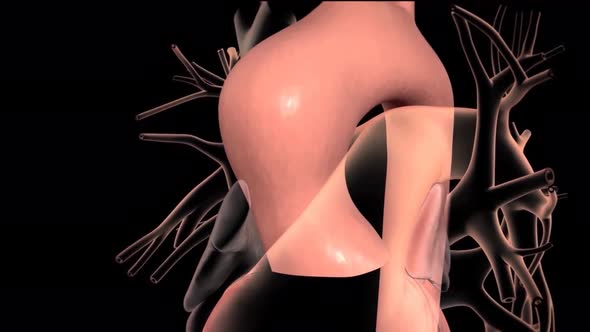 CTA ABDOMINAL AORTA Findings Abdominal aortic aneurysm