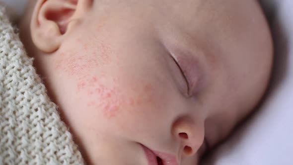 Baby Infant Sleeps with Allergy Dermatitis Rash on Cheek