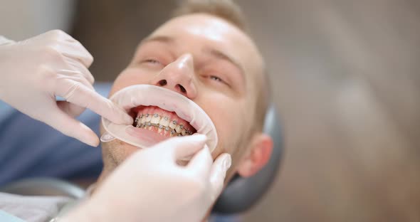 Patient with Dental Braces During an Orthodontic Treatment