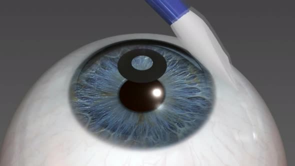 Cataract surgery application view