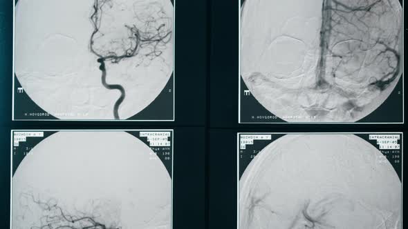 Xray Magnetic Resonance Image of Head