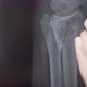 Xray of the Arm Bone - VideoHive Item for Sale