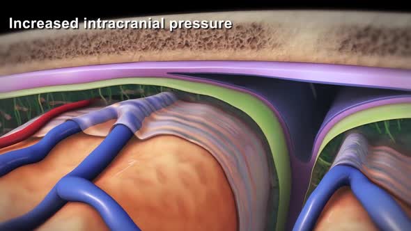 Increased intracranial pressure, brain damage and spinal cord injury