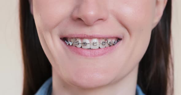 Beautiful Female Smile in Dental Braces with Orthodontic Toothbrushes Closeup