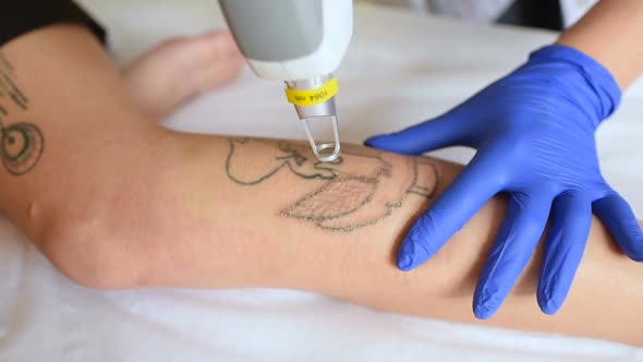 the Cosmetologist Removes the Tattoo on the Leg of a Young Pretty Girl with a Laser