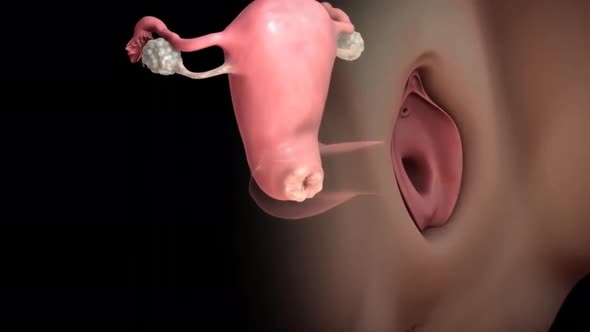 3D Animation of Cervical cancer
