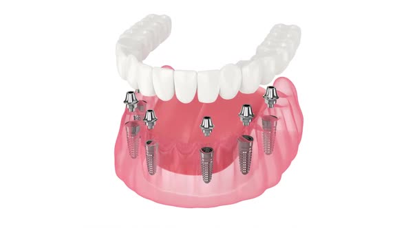 Mandibular prosthesis all on 6 system supported by implants