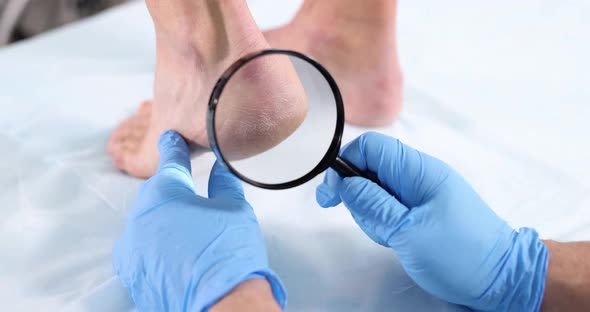 Doctor Examining Skin with Cracks on Heels of Female Patient Using Magnifying Glass Closeup Movie