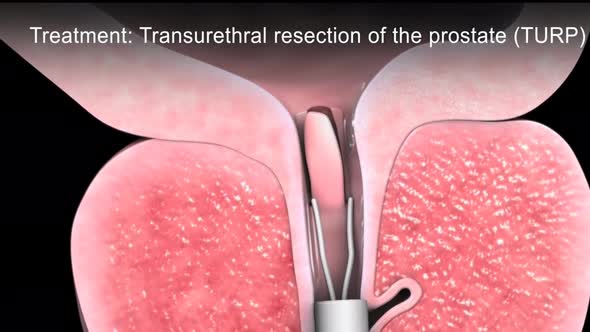 Benign Prostatic Hyperplasia 3d medical