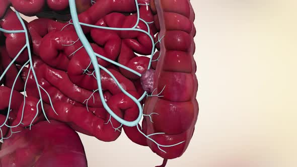 Effects of colon cancer on liver. 3D Medical Animation