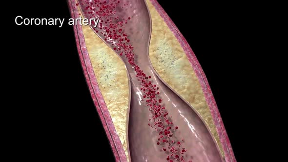 Plaque formation in the cardiovascular system