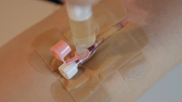 Closeup on the Hand of a Syringe with a Catheter Injection of Medication Dropper