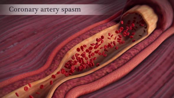 Coronary artery spasm is a brief, sudden narrowing of one of these arteries.