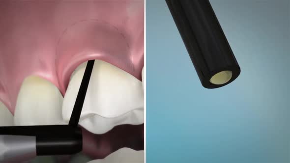 animation of dental procedure