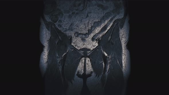 Postoperative Voluminous Color MRI of Female Organs for the Detection of Metastases