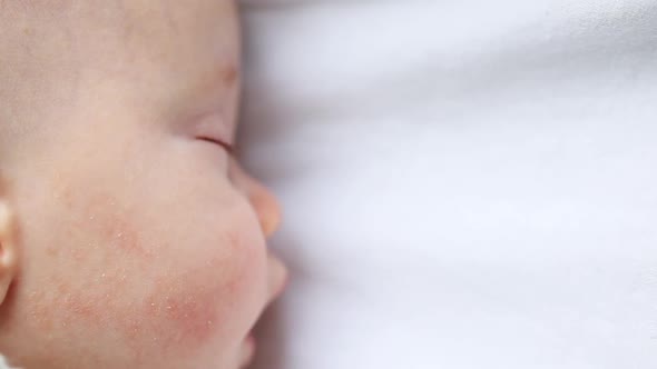 Sleeping Infant with Atopic Dermatitis on Skin Cheek