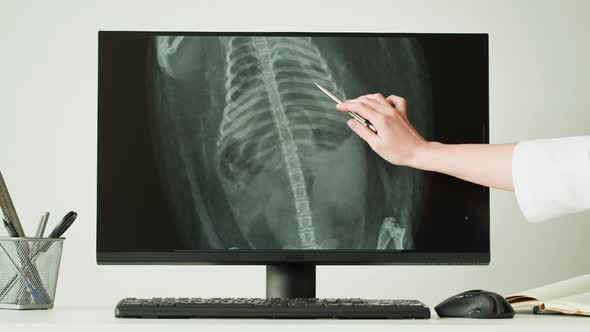 Doctor Veterinarian Examining Hedgehog Skeleton Roentgen on Computer Monitor