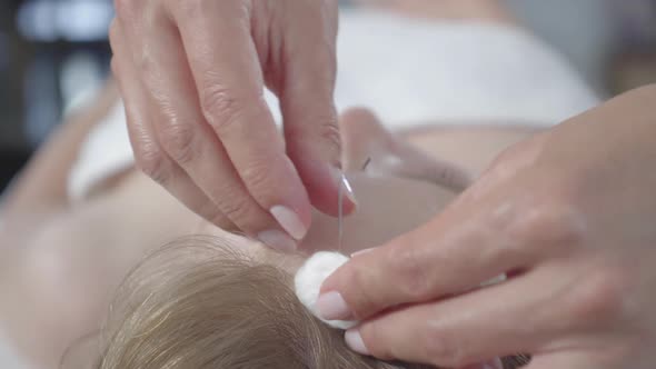 Unrecognizable Doctor Taking Out Needles From Scalp of Female Patient. Close-up Head of Young Blond