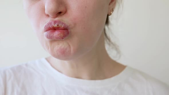 Close Up of Girl Lips Affected By Herpes