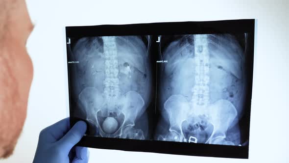 The Doctor Carefully Looks At The X Ray Of The Kidney With A Stone. Oxalate Stone On X Ray