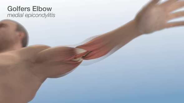 Golfers Elbow - Medial Epicondylitis