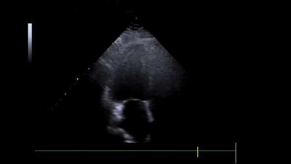 Video Echocardiogram or Cardiac Ultrasound