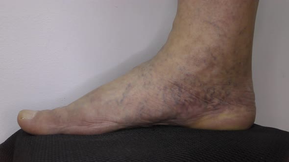 Varicose veins in the male foot.