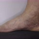 Varicose veins in the male foot. - VideoHive Item for Sale