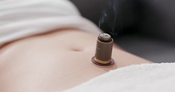 Woman undergo moxibustion therapy 
