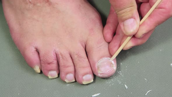 A Man's Hand with an Orange Stick Removes the Cuticle of the Big Toe