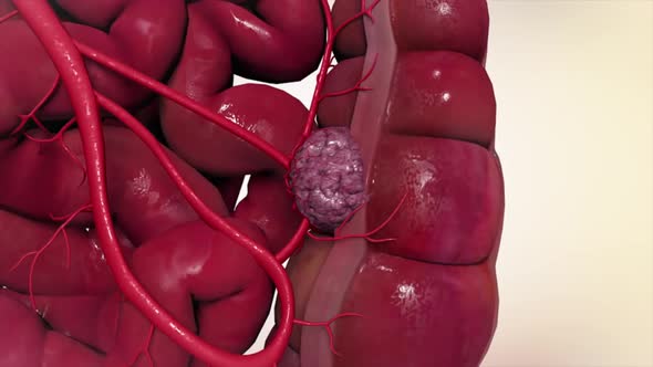 3D Medical animation of colon cancer. Tumor growth