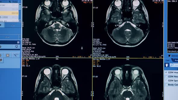 Multiple CT Images of a Brain Show By a Computer Program