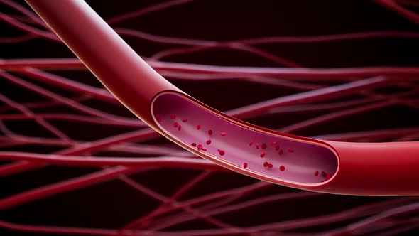 Thrombus Formation in a Vein and Calcium Deposition on the Vessel Walls