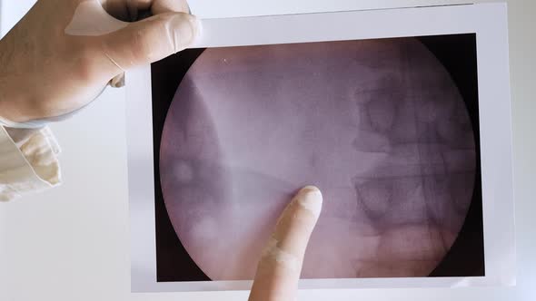 X Ray Of A Kidney With A Stone On A White Background. Doctor Analyzes Oxalate Kidney Stone