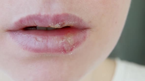 Close Up of Girl Lips Affected By Herpes
